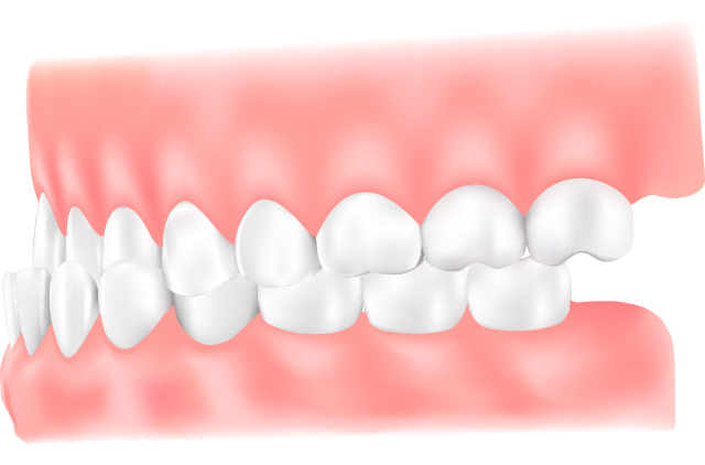 下顎前突（受け口）