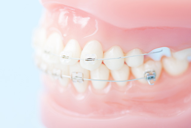 ワイヤー矯正のついた歯の模型